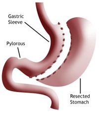 gastric-sleeve-surgery-sm