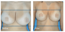 breast body tite Before & After