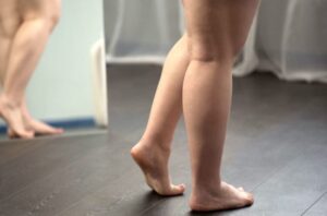 Lipedema Legs