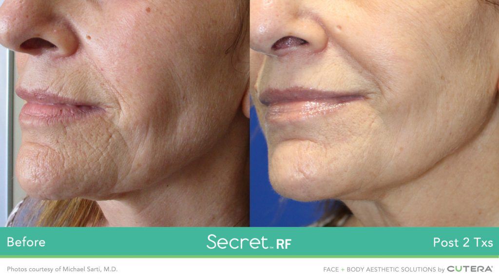 Laser Skin Rejuvenation Secret RF 13