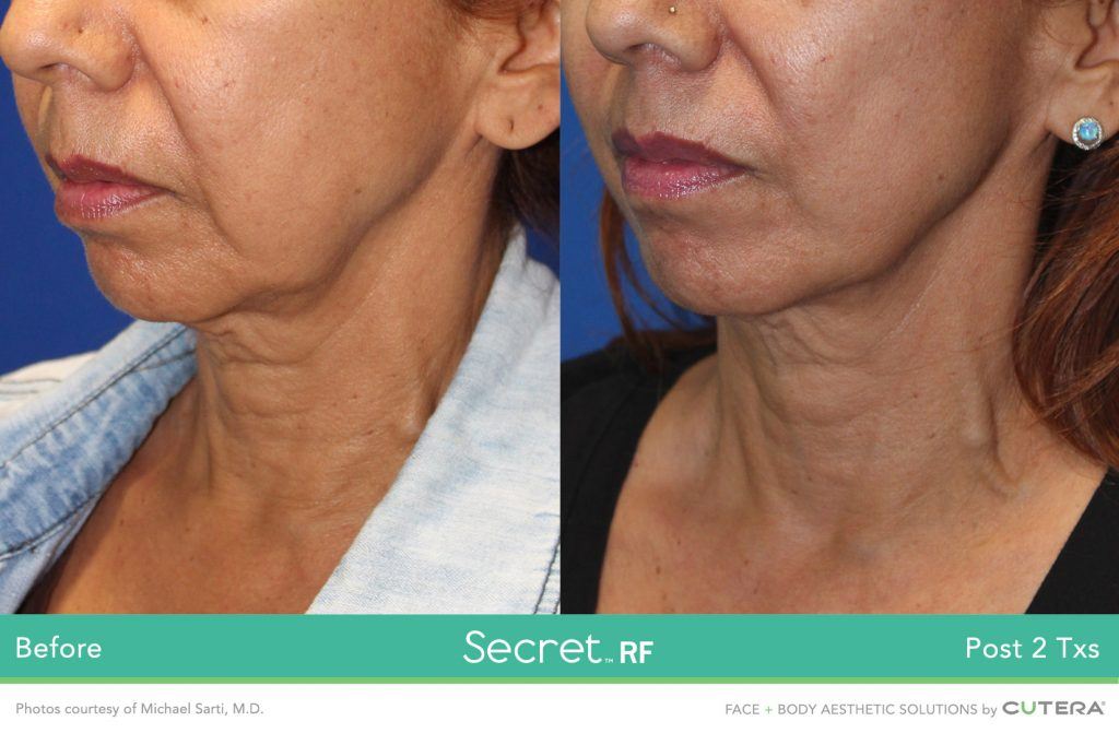 Laser Skin Rejuvenation Secret RF