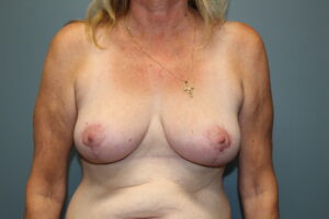 Breast Reduction - Case 3071 - After