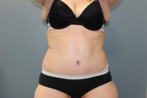 Tummy Tuck - Case 3073 - After