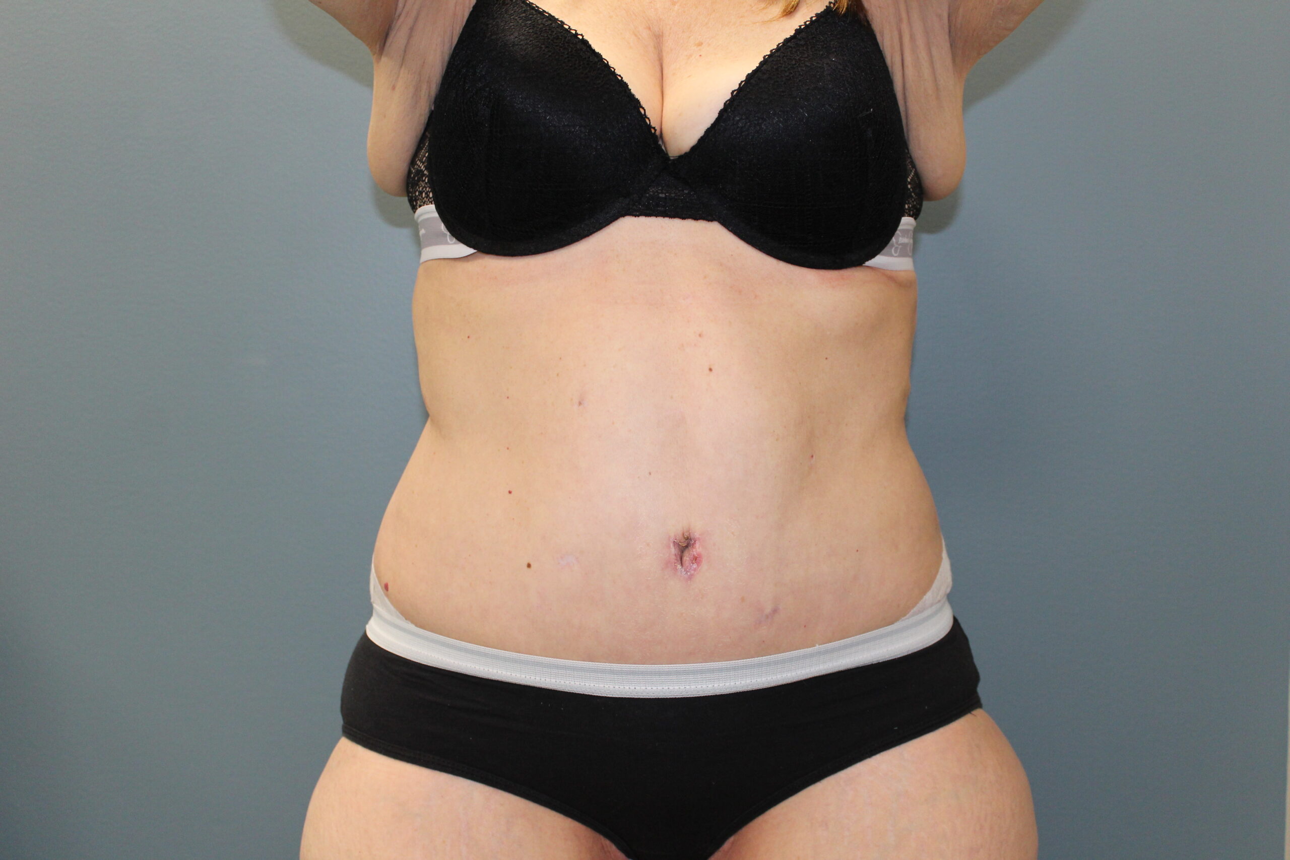 Tummy Tuck Patient Photo - Case 3073 - after view