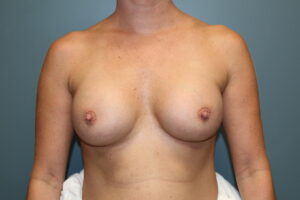 Breast Augmentation - Case 3075 - After