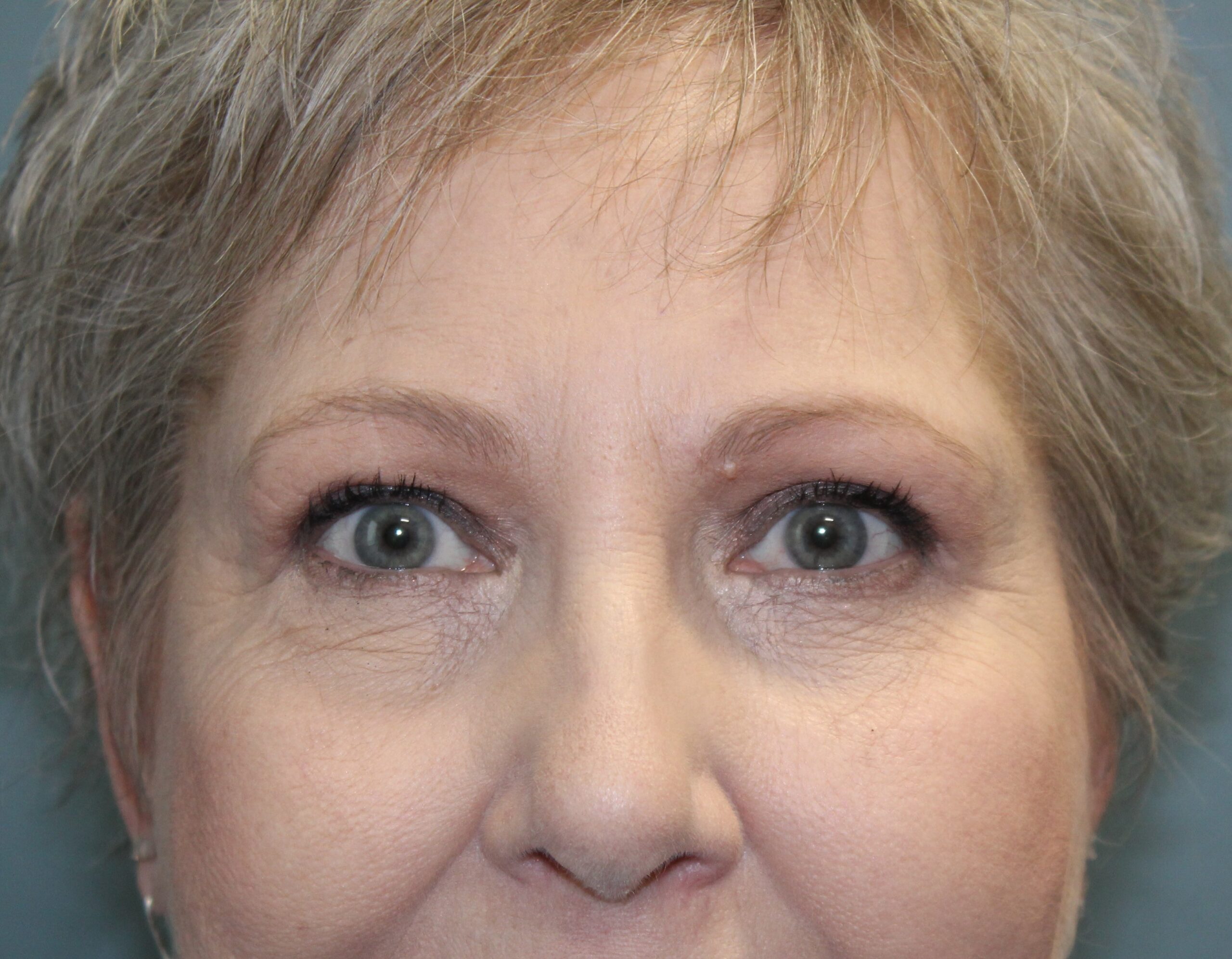 Blepharoplasty Patient Photo - Case 3074 - after view-0