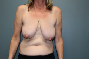 Breast Reduction - Case 3071 - Before