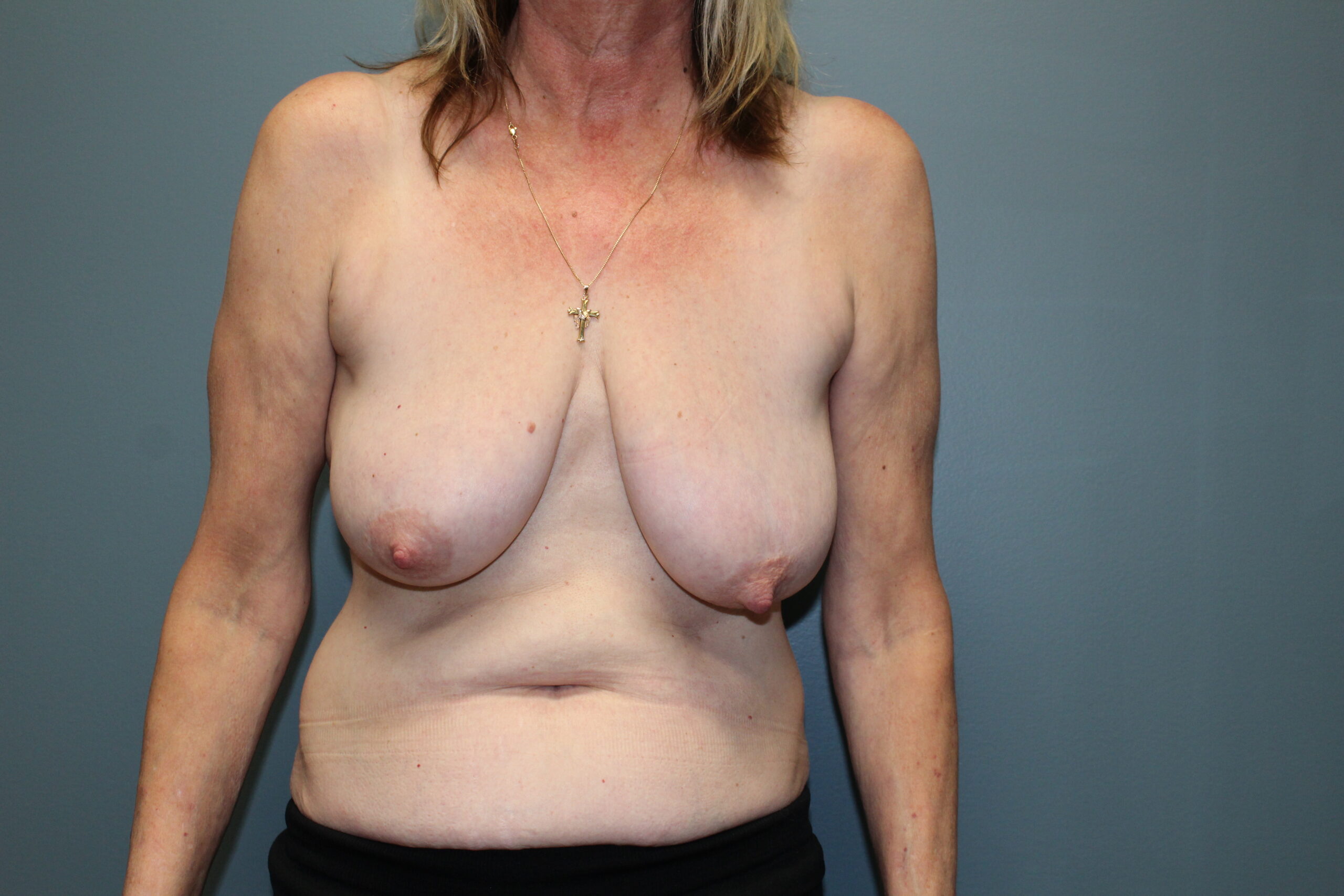 Breast Reduction Patient Photo - Case 3071 - before view-