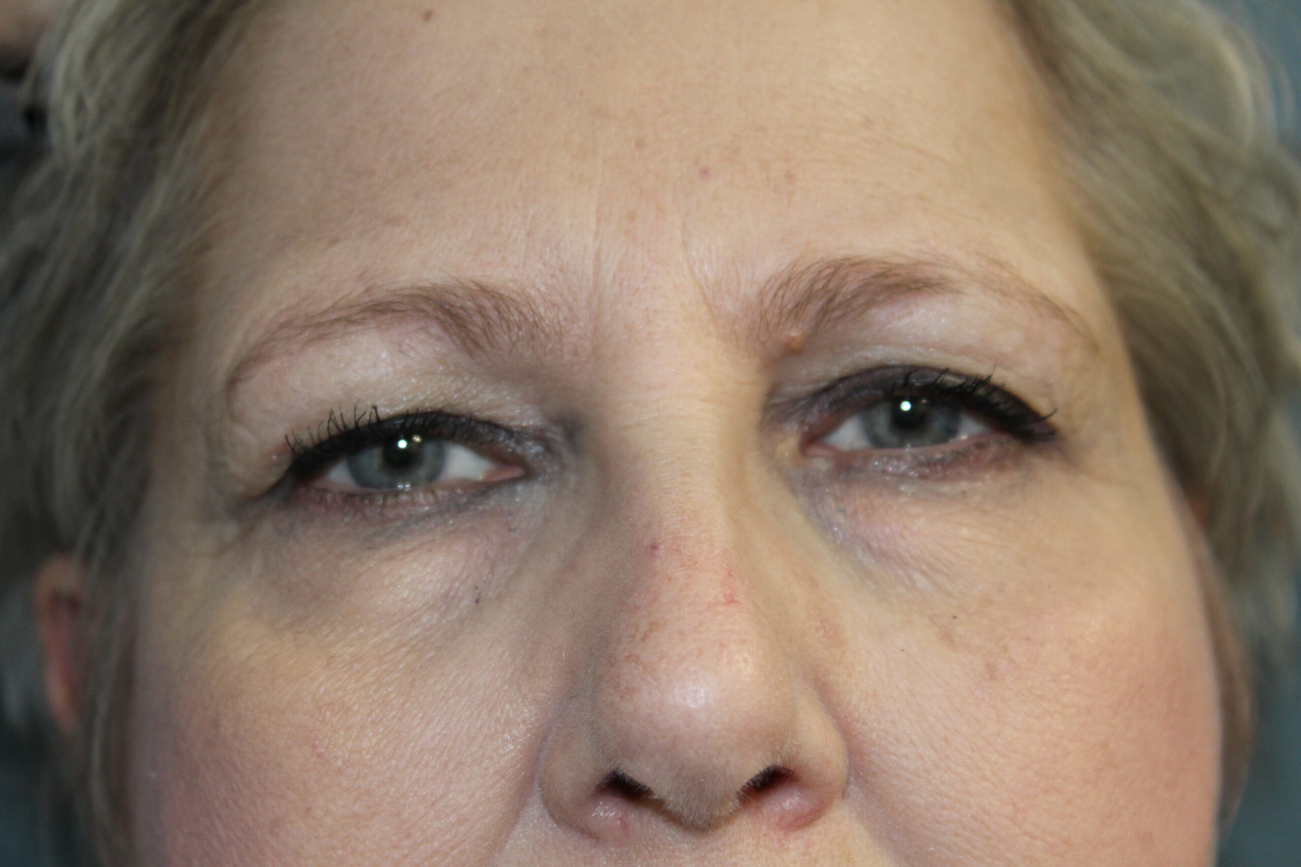Blepharoplasty Patient Photo - Case 3074 - before view-