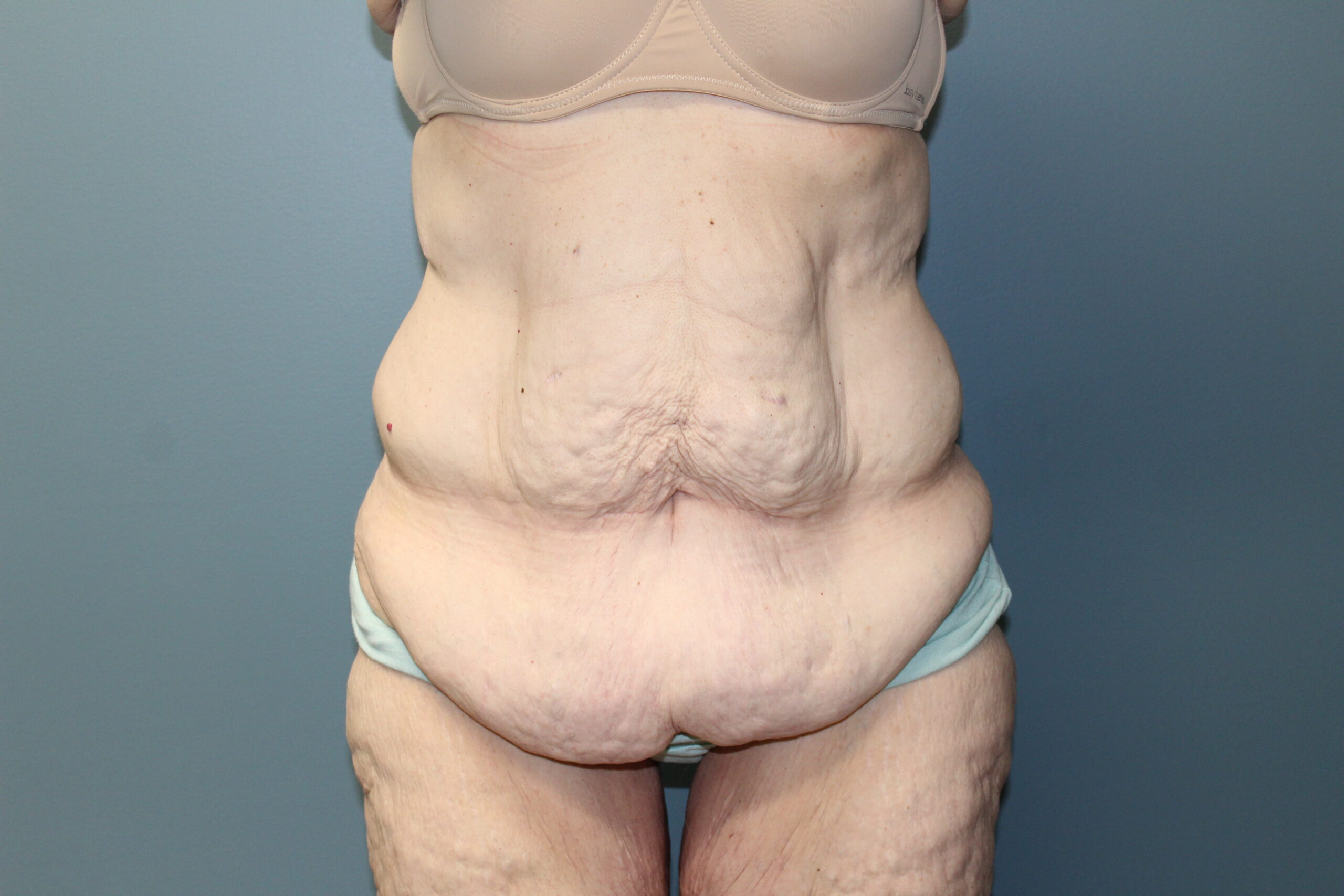 Tummy Tuck Patient Photo - Case 3073 - before view-