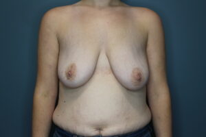Breast Augmentation - Case 3099 - Before