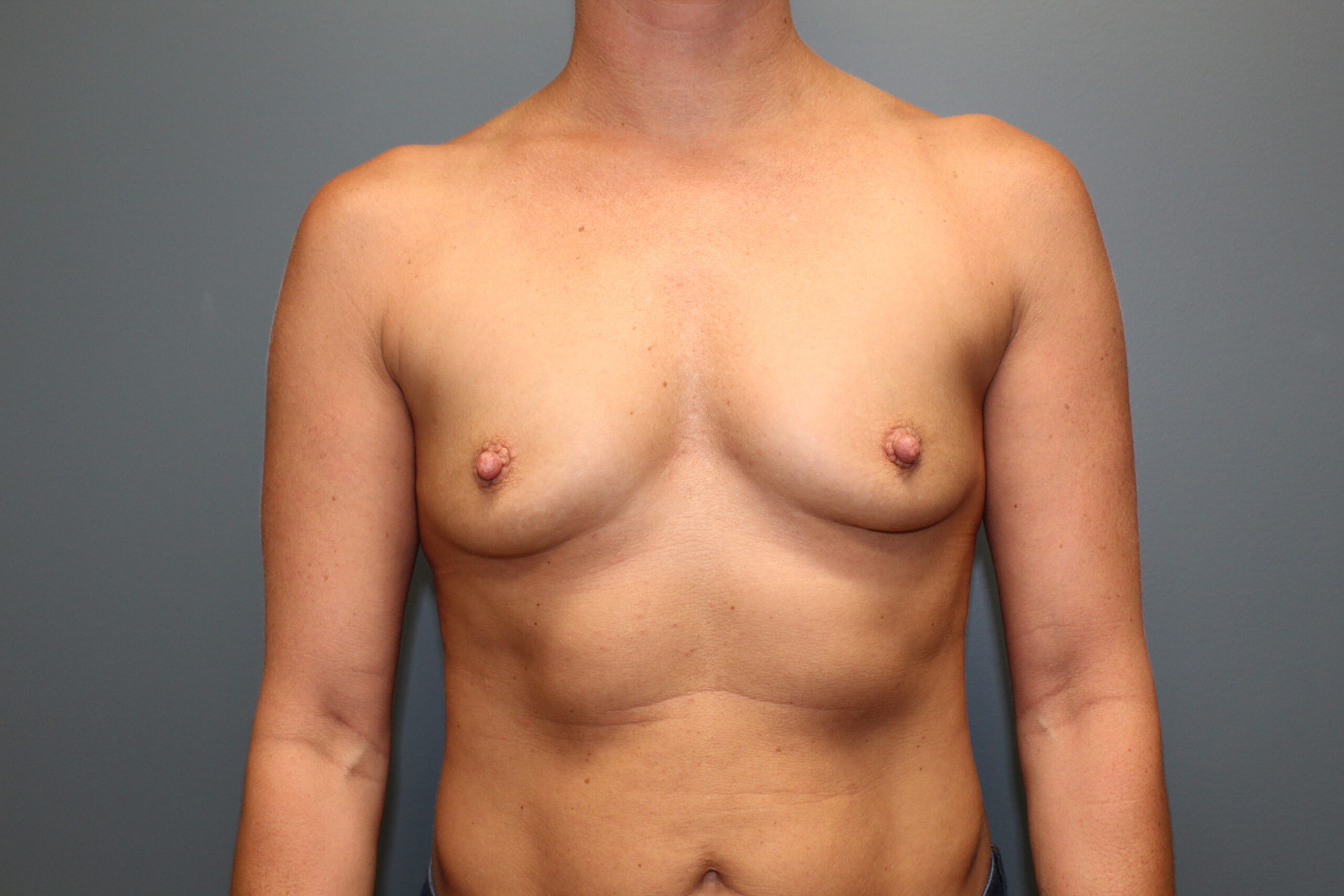 Breast Augmentation Patient Photo - Case 3075 - before view-