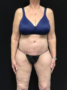 After Weight Loss - Case 2797 - After