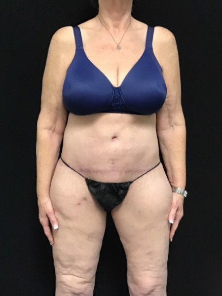 After Weight Loss Patient Photo - Case 2797 - after view