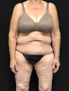 After Weight Loss - Case 2797 - Before
