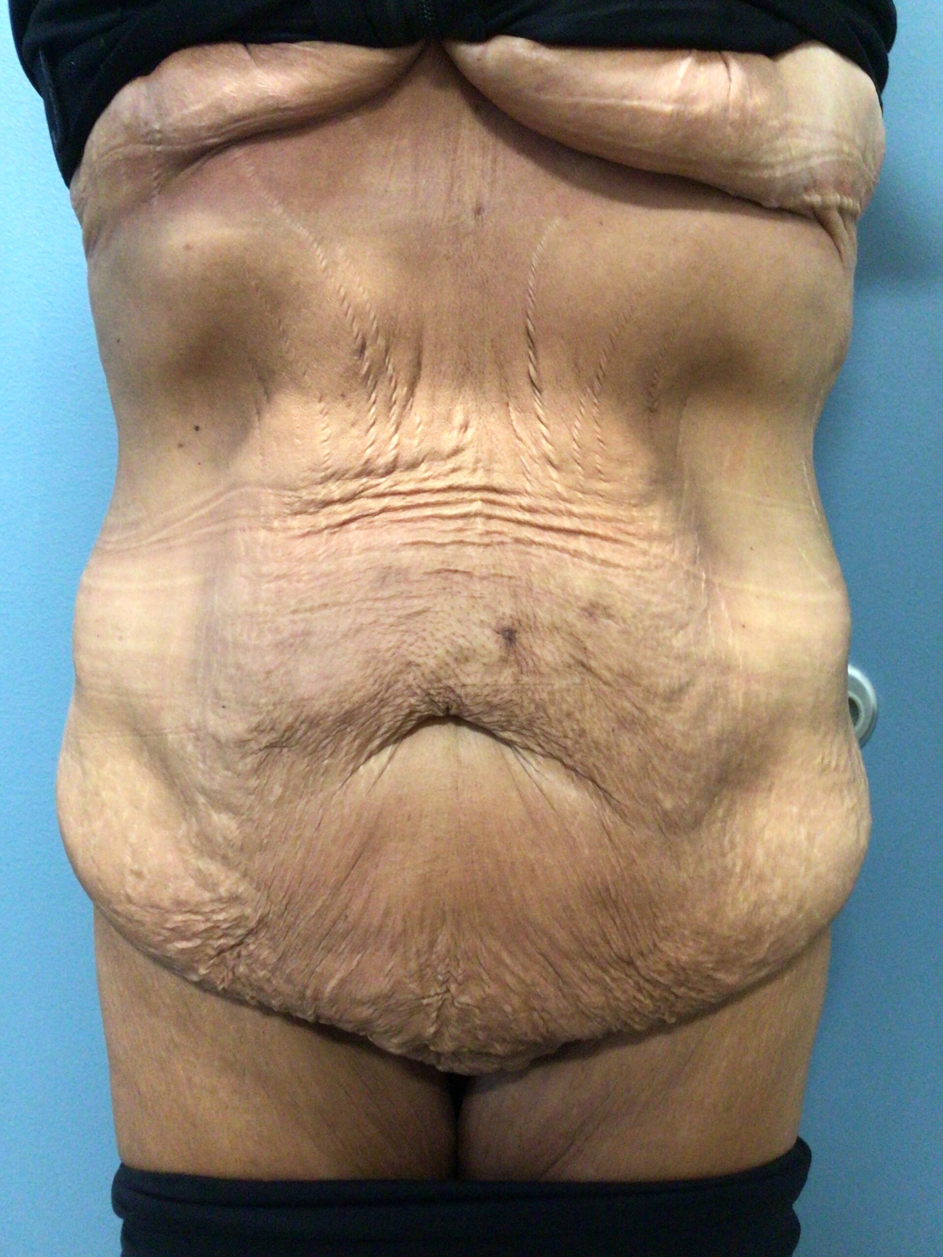 After Weight Loss Patient Photo - Case 2800 - before view-0