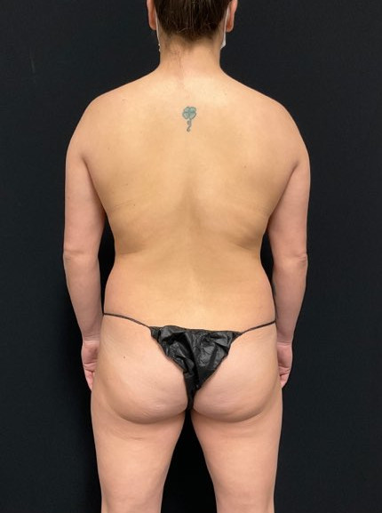 Brazilian Butt Lift Patient Photo - Case 2809 - before view-