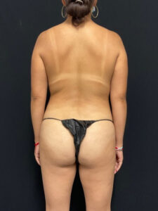Brazilian Butt Lift - Case 2812 - Before