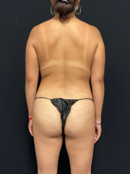 Brazilian Butt Lift Patient Photo - Case 2812 - before view-