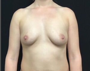 Breast Augmentation - Case 2818 - Before