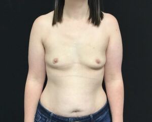 Breast Augmentation - Case 2824 - Before