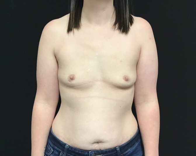 Breast Augmentation Patient Photo - Case 2824 - before view-0