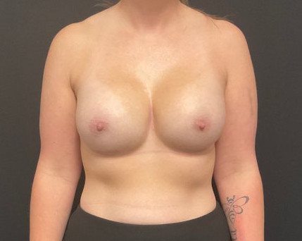 Breast Augmentation Patient Photo - Case 2824 - after view