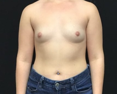 Breast Augmentation Patient Photo - Case 2839 - before view-0