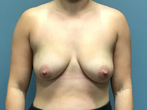 Breast Augmentation - Case 2842 - Before