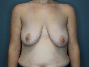 Breast Augmenation with Lift - Case 2845 - Before