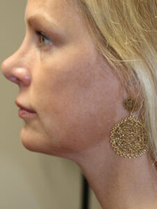 Evoke Facial Remodeling - Case 2857 - After