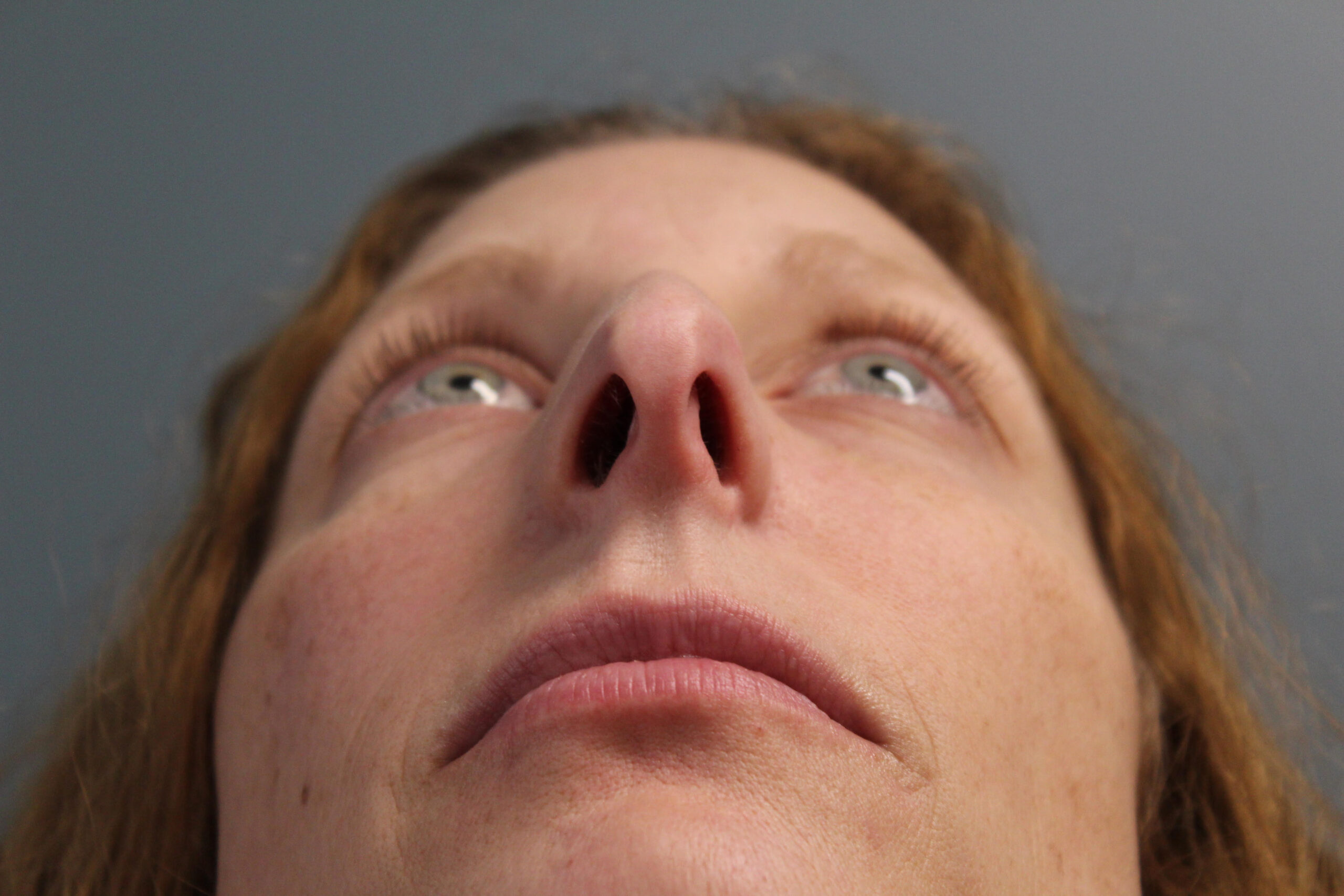 Rhinoplasty Patient Photo - Case 2880 - before view-1