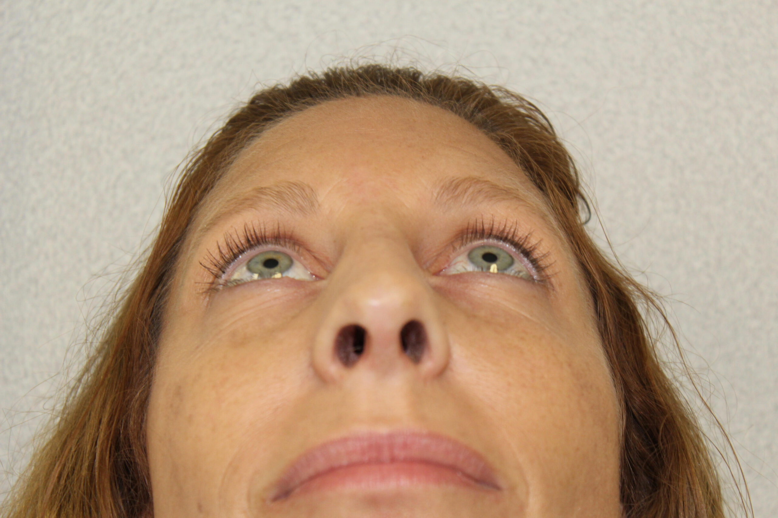 Rhinoplasty Patient Photo - Case 2880 - after view-1