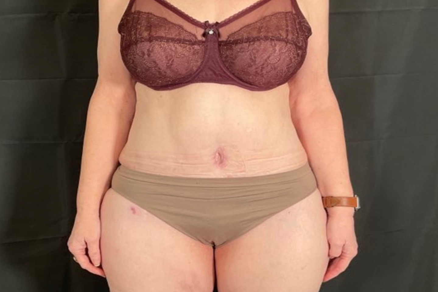 Tummy Tuck Patient Photo - Case 2885 - after view-0
