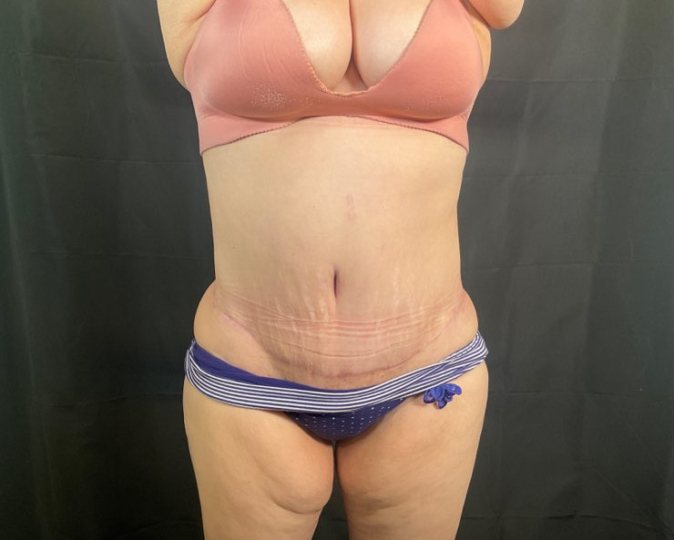 Tummy Tuck Patient Photo - Case 2888 - after view-0
