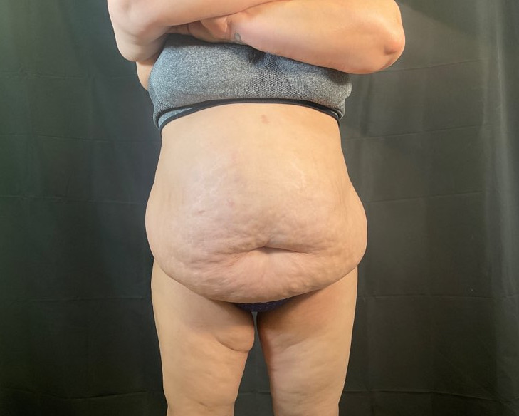 Tummy Tuck Patient Photo - Case 2888 - before view-0