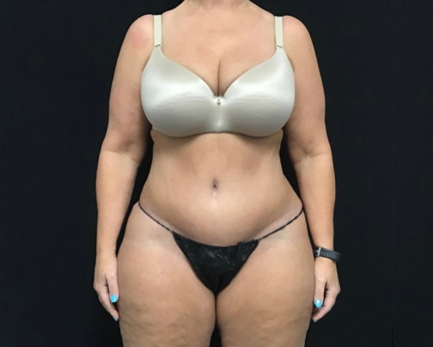 Tummy Tuck Patient Photo - Case 2891 - after view