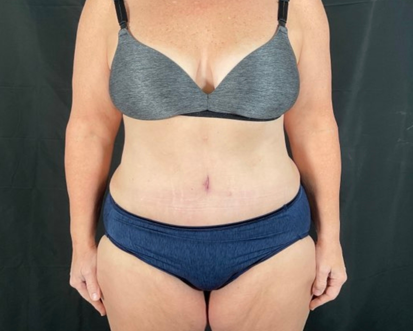 Tummy Tuck Patient Photo - Case 2894 - after view