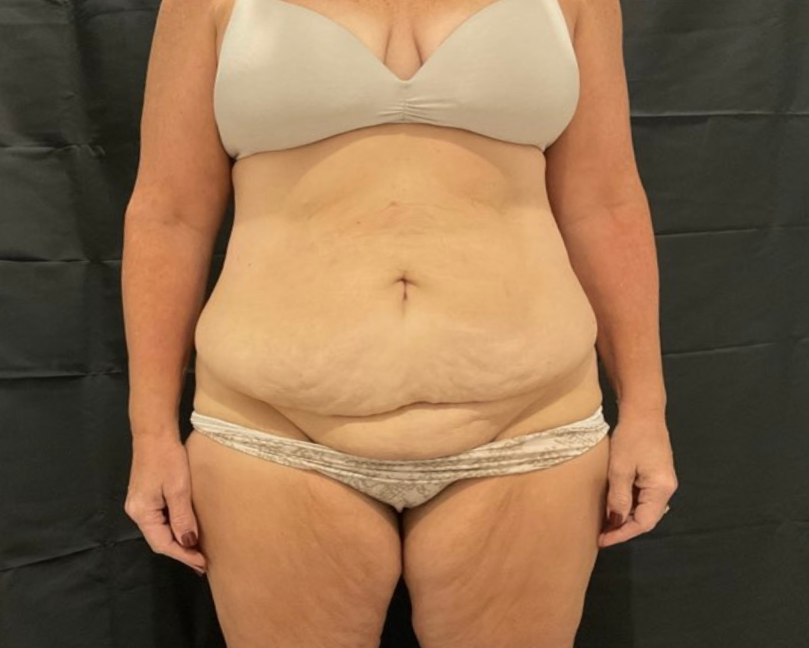 Tummy Tuck Patient Photo - Case 2894 - before view-0