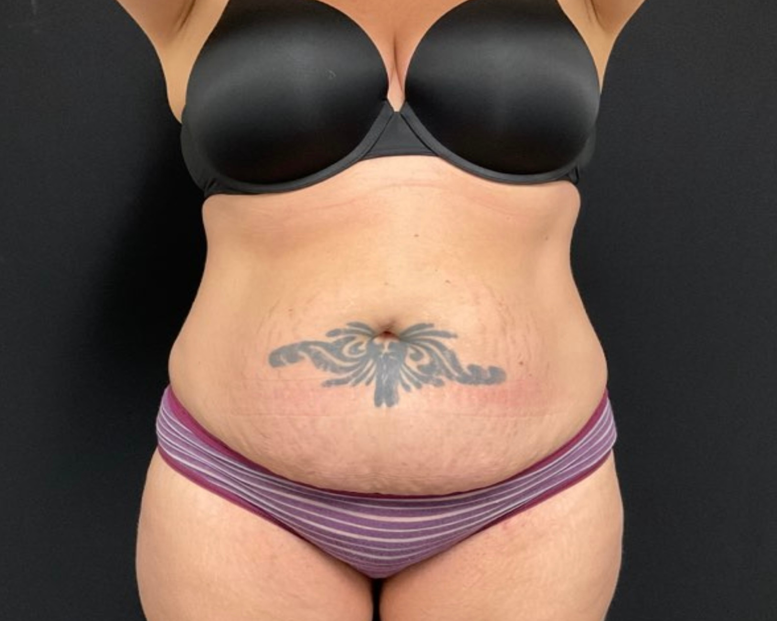 Tummy Tuck Patient Photo - Case 2898 - before view-