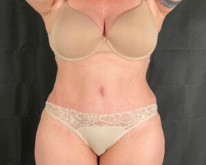 Tummy Tuck - Case 2898 - After