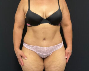 Tummy Tuck - Case 2901 - After