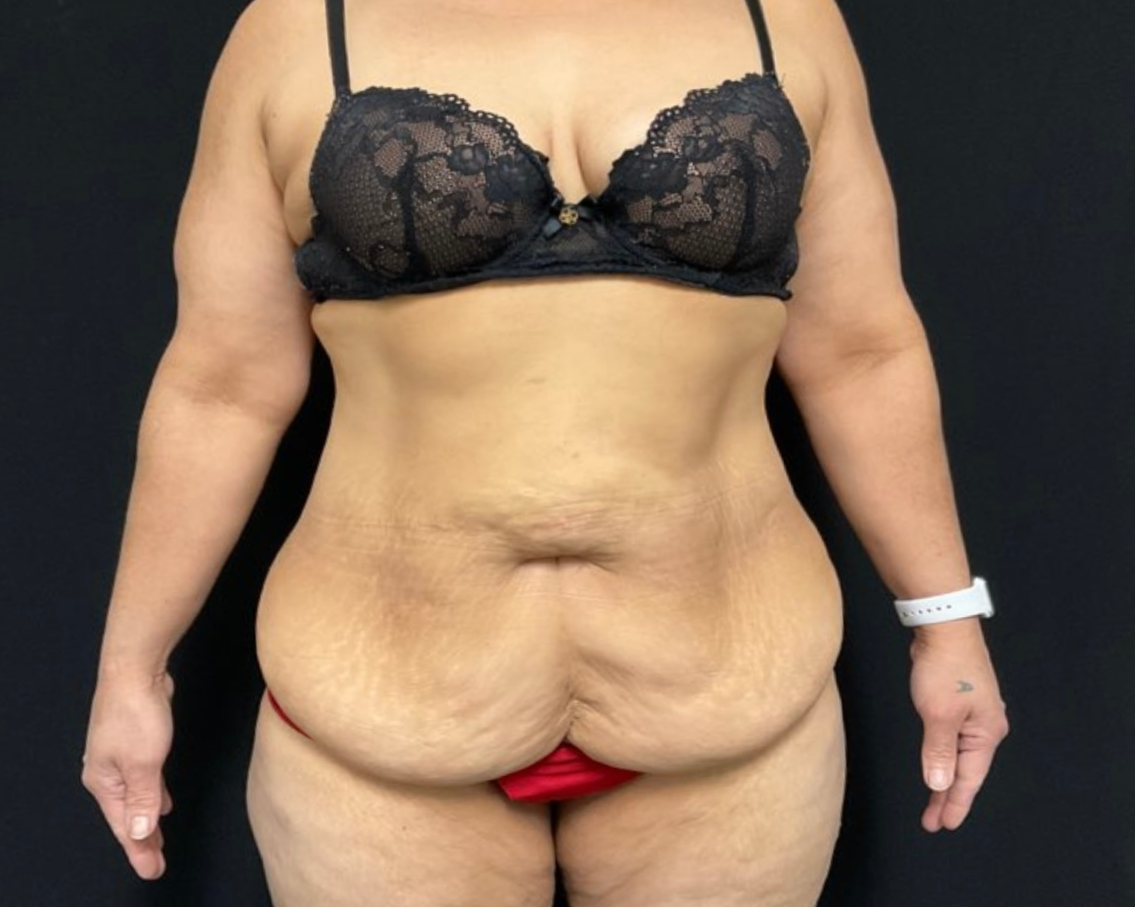 Tummy Tuck Patient Photo - Case 2901 - before view-