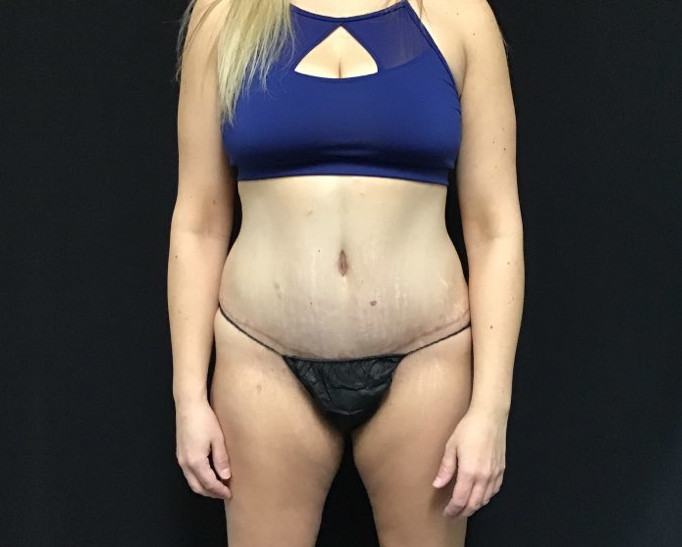 Tummy Tuck Patient Photo - Case 2904 - after view-0
