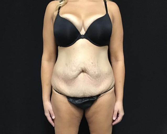 Tummy Tuck Patient Photo - Case 2904 - before view-