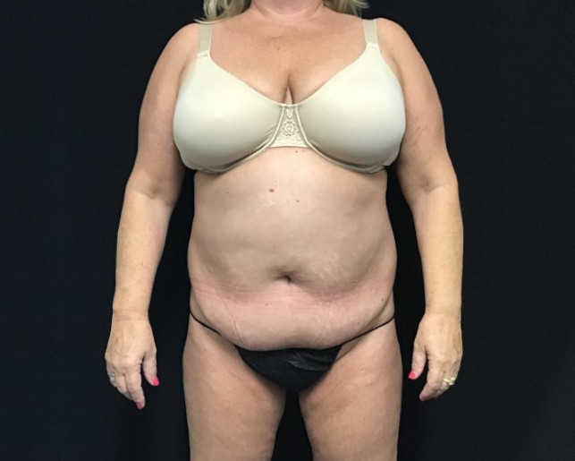 Tummy Tuck Patient Photo - Case 2907 - before view-