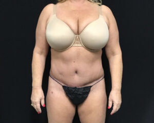 Tummy Tuck - Case 2907 - After
