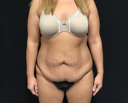 Tummy Tuck Patient Photo - Case 2910 - before view-0