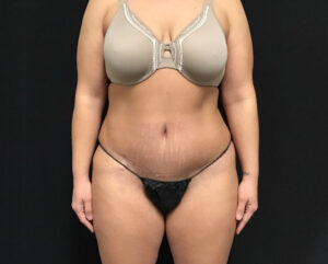 Tummy Tuck - Case 2910 - After