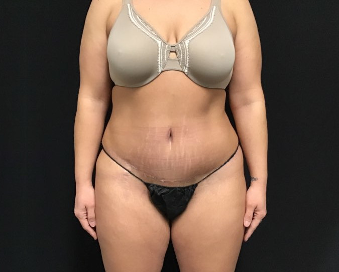 Tummy Tuck Patient Photo - Case 2910 - after view-0
